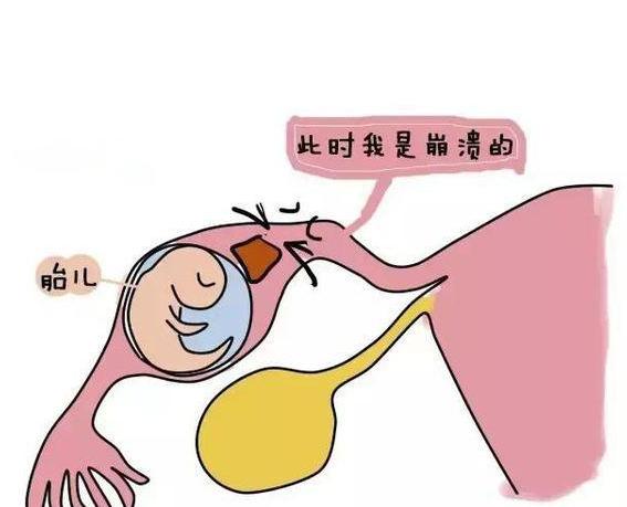 女人宫外孕一般是什么原因造成的,女性宫外孕是什么原因引起的