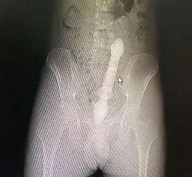 一条罗非鱼“游”进肛门?医生:直肠不直,进去容易出来难