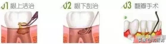 牙龈萎缩牙齿松动中医有什么方法,牙齿松动怎么办教你一招恢复