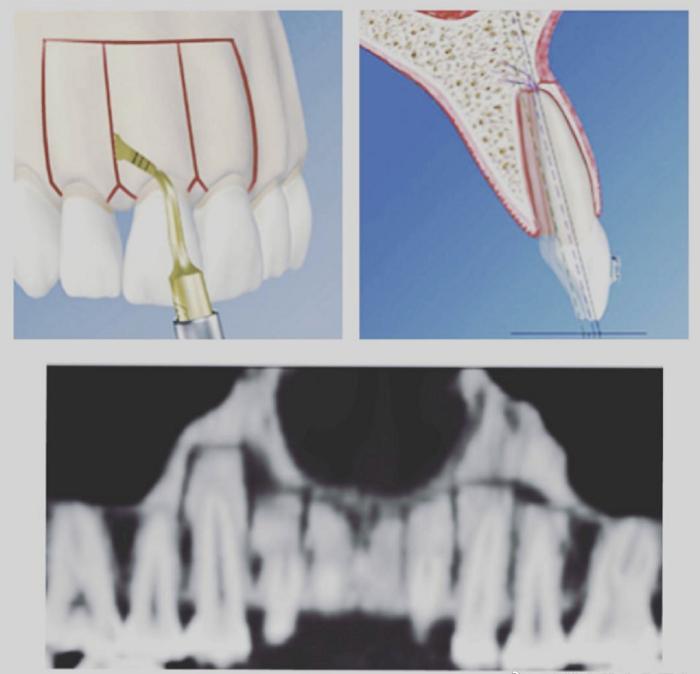 骨性地包天不做正颌手术最好方法,骨性地包天不做手术可矫正吗