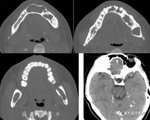 颅内有钙化怎么治疗,34岁脑部有钙化正常吗