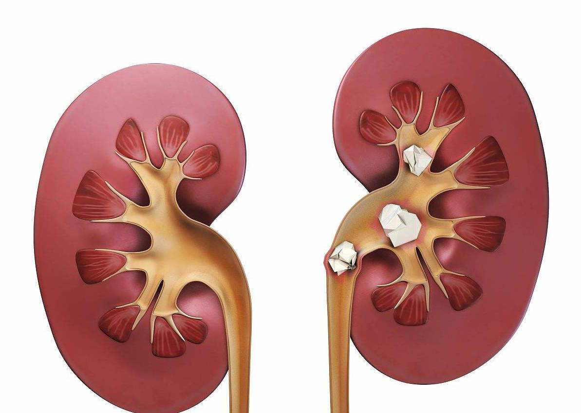 罕见肾部疾病，多发性肾囊肿，了解患病的多种原因，做到积极预防