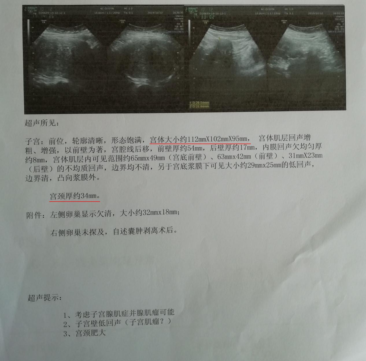 她得了这个怪病后，每次来月经都要用掉15片纸尿裤、60片姨妈巾