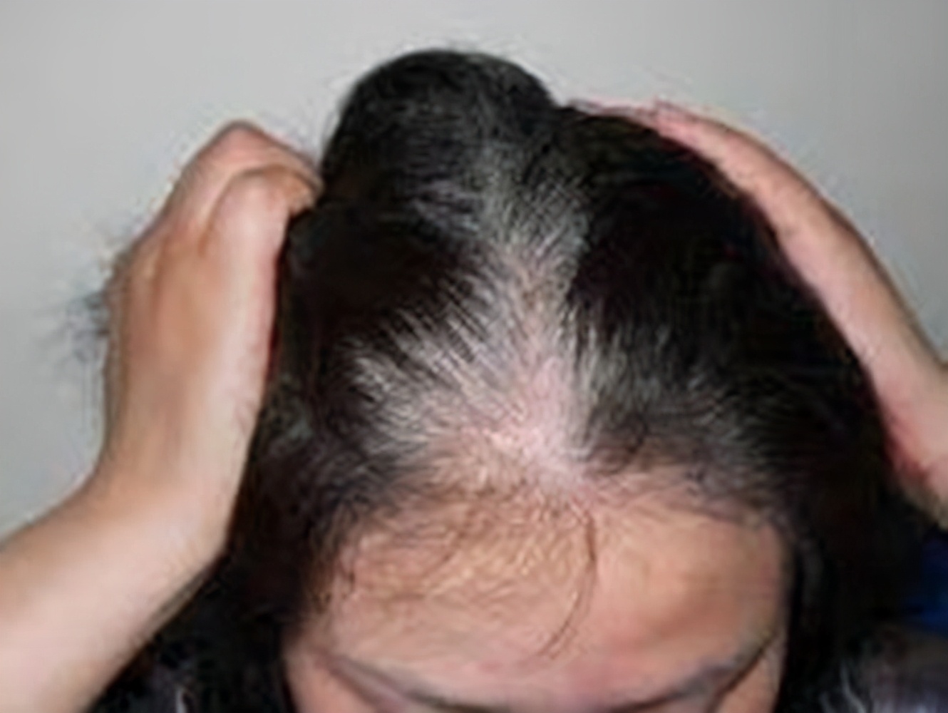 头发油掉发脱发很严重怎么办,掉发脱发严重有什么好办法改善吗