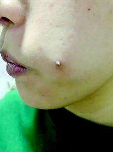 女子打钢钉“种”酒窝致脸颊发炎，纹身培训学校：管打不管取