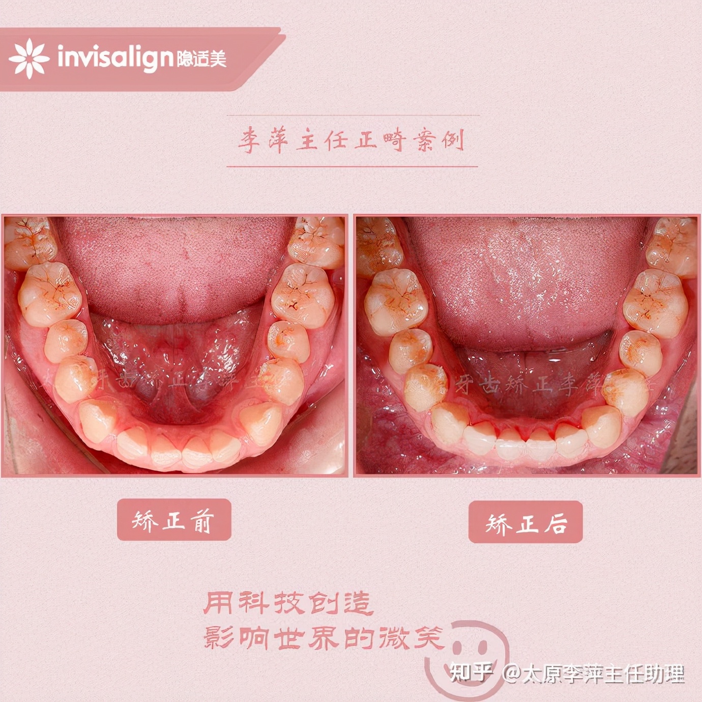 太原牙齿矫正靠谱吗,太原成人隐形牙套牙齿不齐