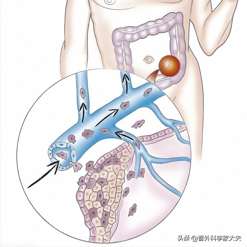 提高肠癌的免疫力吃什么好,提高直肠癌诊断率的简便有效措施