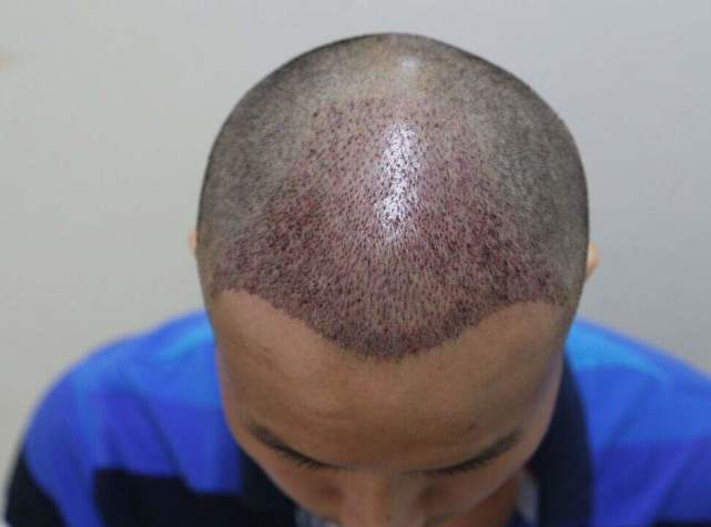 植发手术麻醉过程疼吗,植发手术麻醉过了会不会痛