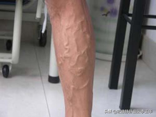 血管变粗就是静脉曲张？你了解的静脉曲张是怎样的？
