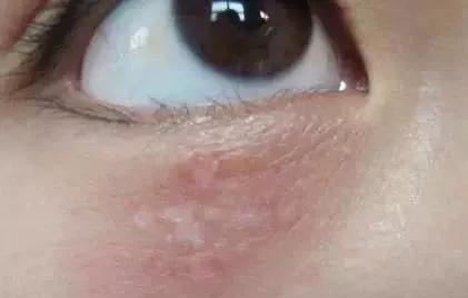 长了汗管瘤容易长皱纹,为什么会长汗管瘤和脂肪粒