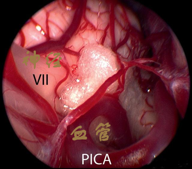 还在用损坏神经的方式治疗三叉神经痛？小心造成面部麻木甚至面瘫