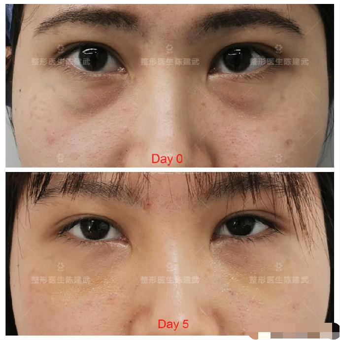 眼袋黑眼圈最好的解决方法,眼袋加黑眼圈最好的解决办法