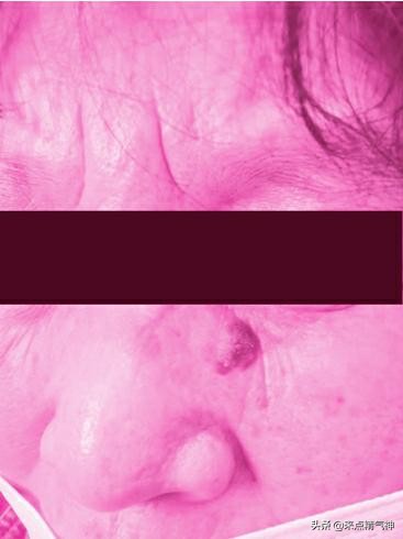 脸上的痣越长越大和癌症的关系,脸上长痣好不好专家回答