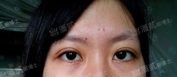 原来双眼皮不好看有必要继续割吗,割双眼皮是不是越修复越难看