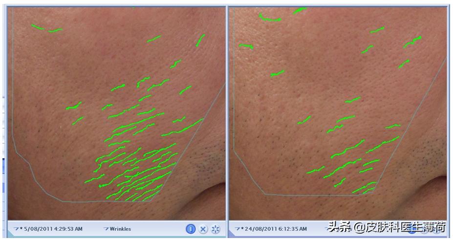 医美皮肤科医生介绍,医美小知识光子嫩肤