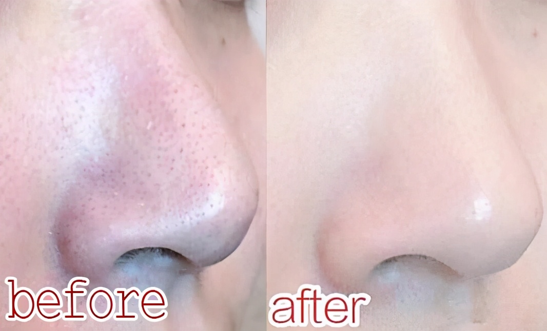 仅因价格便宜被忽视，李佳琦：用3次黑头闭口就没了