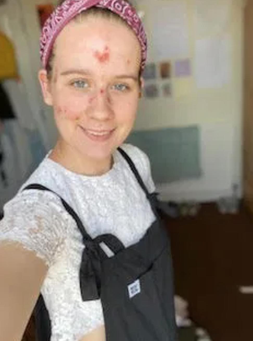 外国女起夜撒尿未果，从此竟再也尿不出，终身导尿还进精神病院