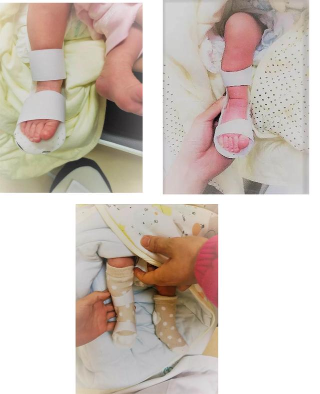 足内翻拇外翻是什么原因,足内翻足外翻的解决方法