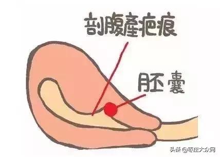 胚胎在疤痕附近怎么办,胚胎着床在子宫疤痕处怎么办