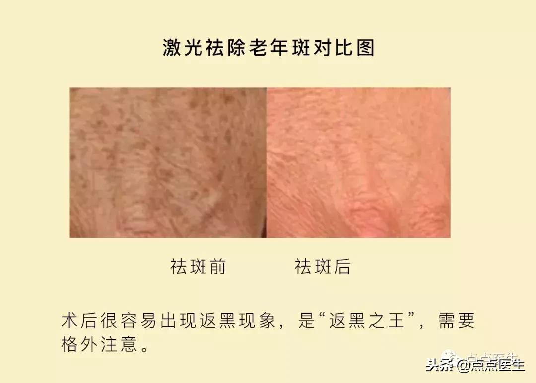 抗衰一定要用医美吗,什么激光抗衰好