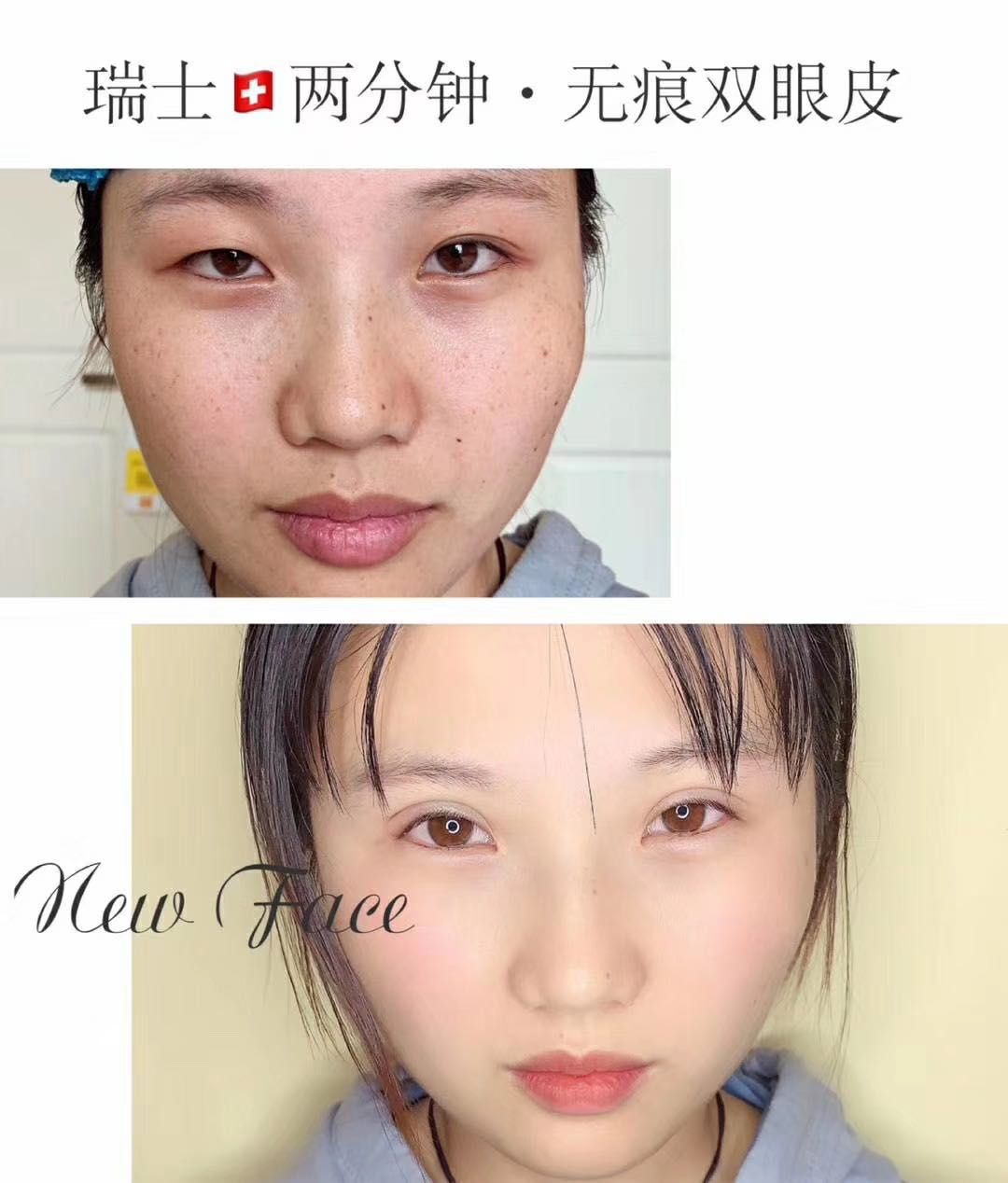 双眼皮手术睁眼闭眼效果,双眼皮手术怎么看着不假