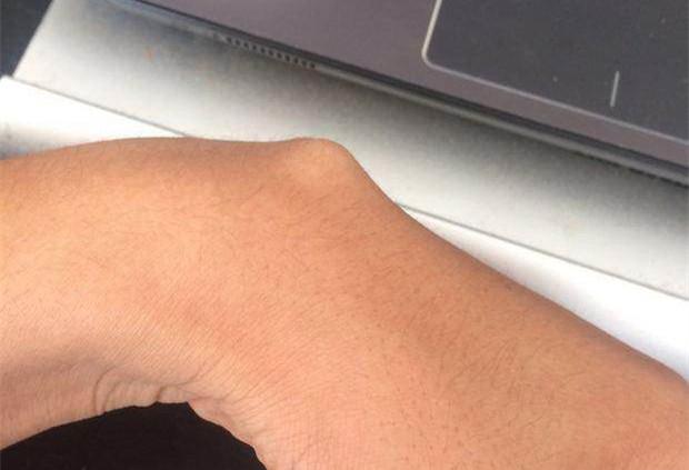 腱鞘囊肿拆线后如何护理,足背腱鞘囊肿术后怎么护理