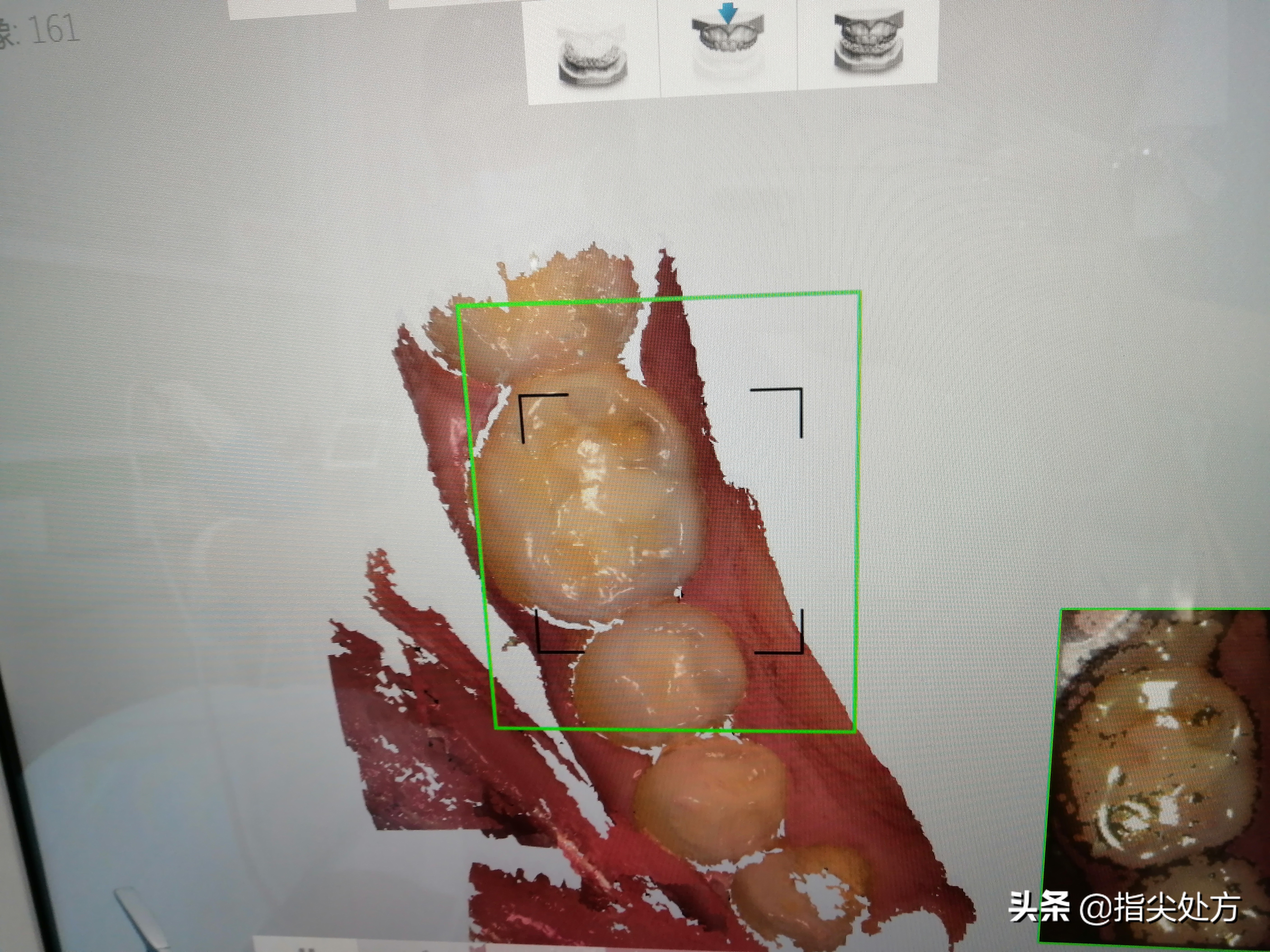 儿童牙外伤的高发年龄,暑期游玩谨防儿童外伤