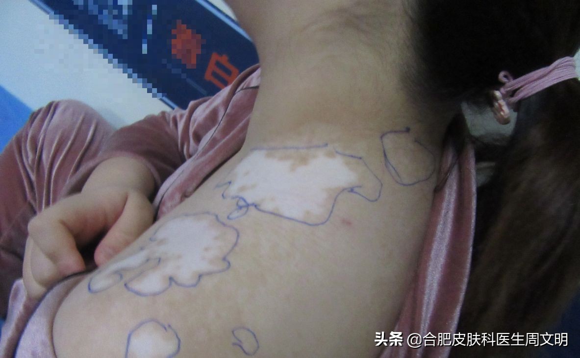 大面积白癜风打什么针可以全白,大面积白癜风吃啥药抑制黑色素