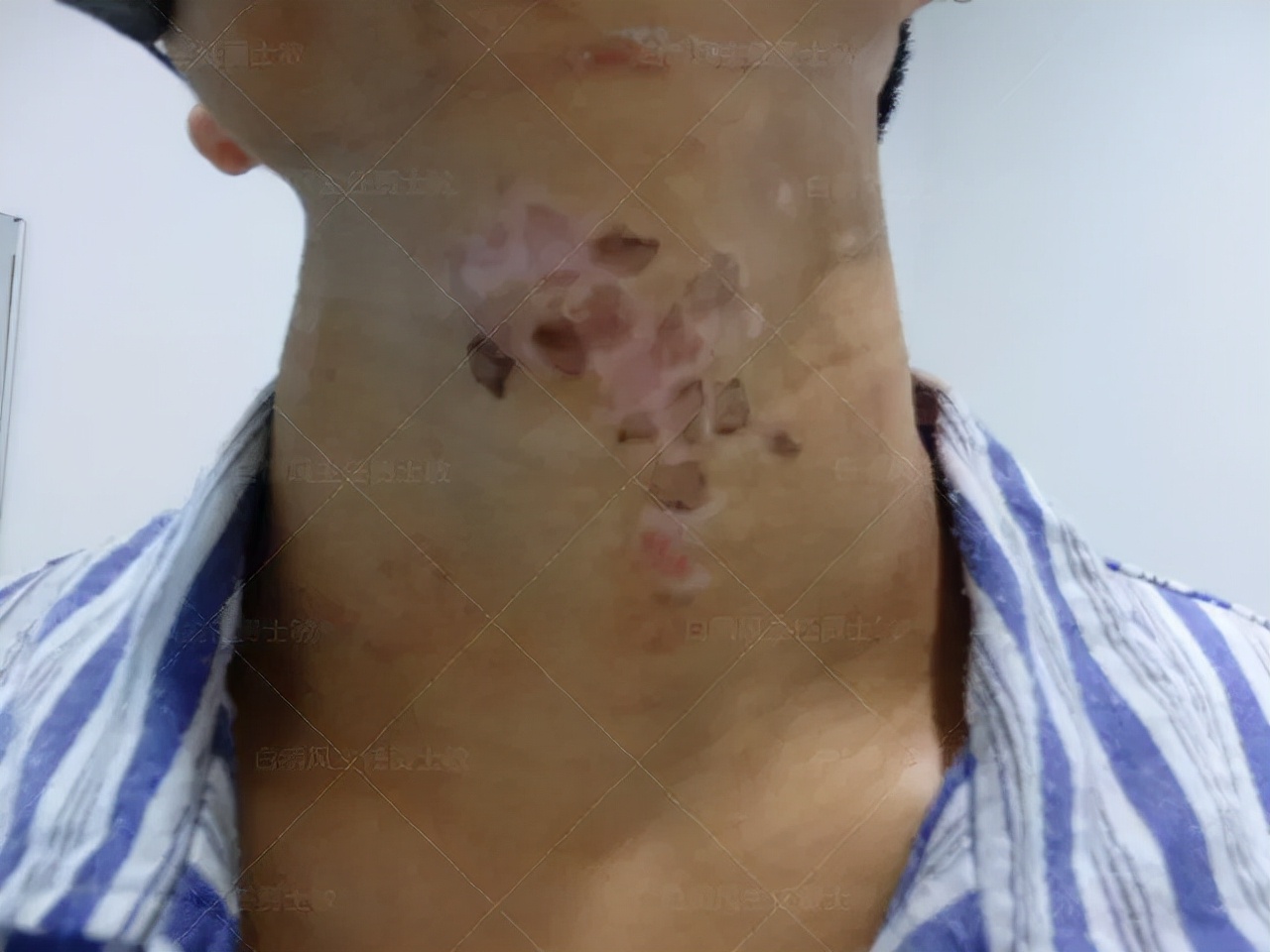 18岁男孩高考备战,18岁男孩白斑