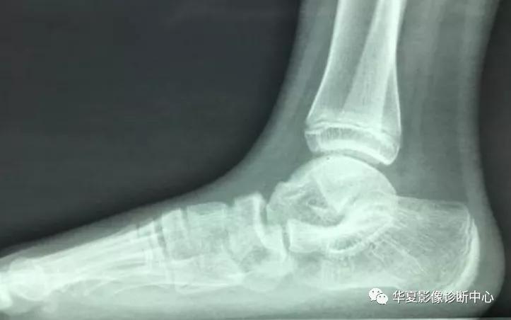 跗骨联合,跗骨与跖骨解剖图