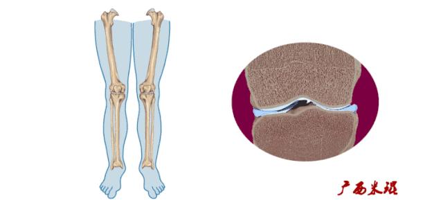 有关半月板的疾病与治疗,听骨科医生讲的话