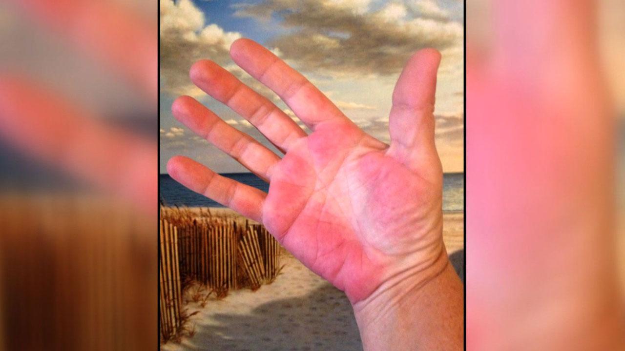 有肝掌蜘蛛痣得肝硬化的几率大吗,有肝掌和蜘蛛痣一定是肝硬化么