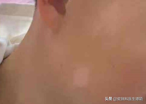 桃花癣是什么引起的,桃花癣是怎么样的症状