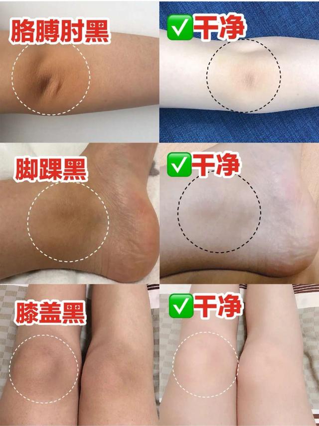 洗澡搓泥后起疙瘩,洗澡时搓出来的泥是怎么回事