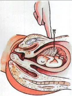 引产对女性身体伤害大，不想生下孩子，“打胎”越早伤害性越小