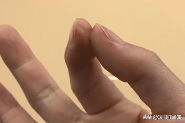 502胶水把两个手指粘在一起怎么办,手指和塑料被502粘到一起怎么办