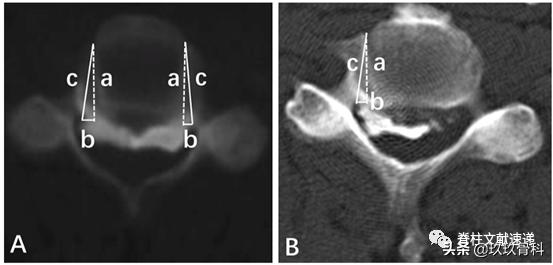 acaf手术适应脊髓型颈椎病吗,acaf术后康复方法