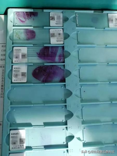 女子被猫抓了一下,五岁女孩被猫抓了一下