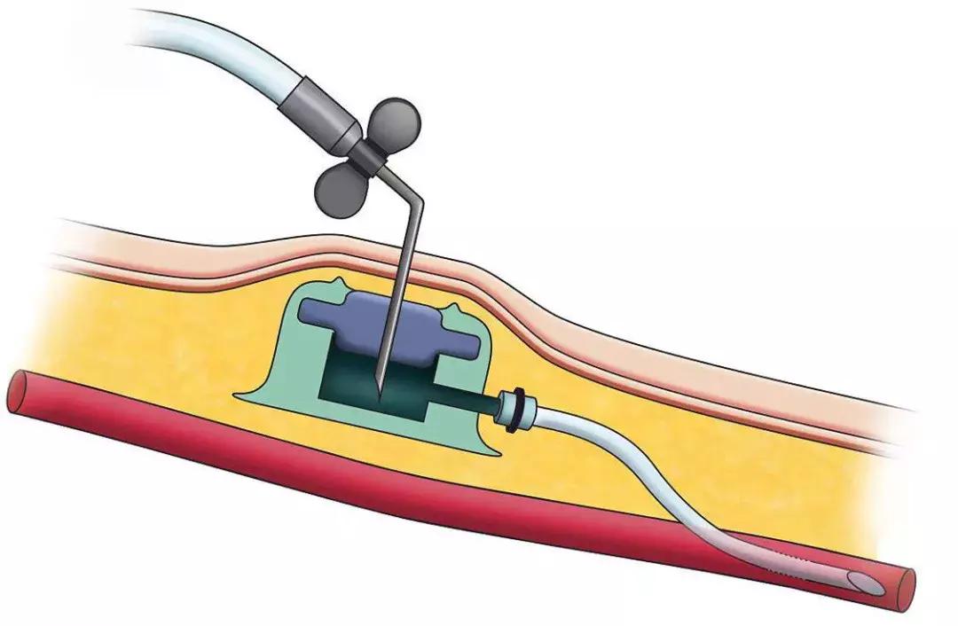 医院首例下腔静脉滤器植入,静脉输液港植入后效果图
