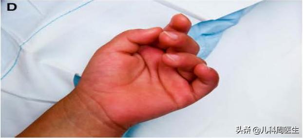 川崎病的孩子为啥容易感冒,怎样确诊儿童得了川崎病