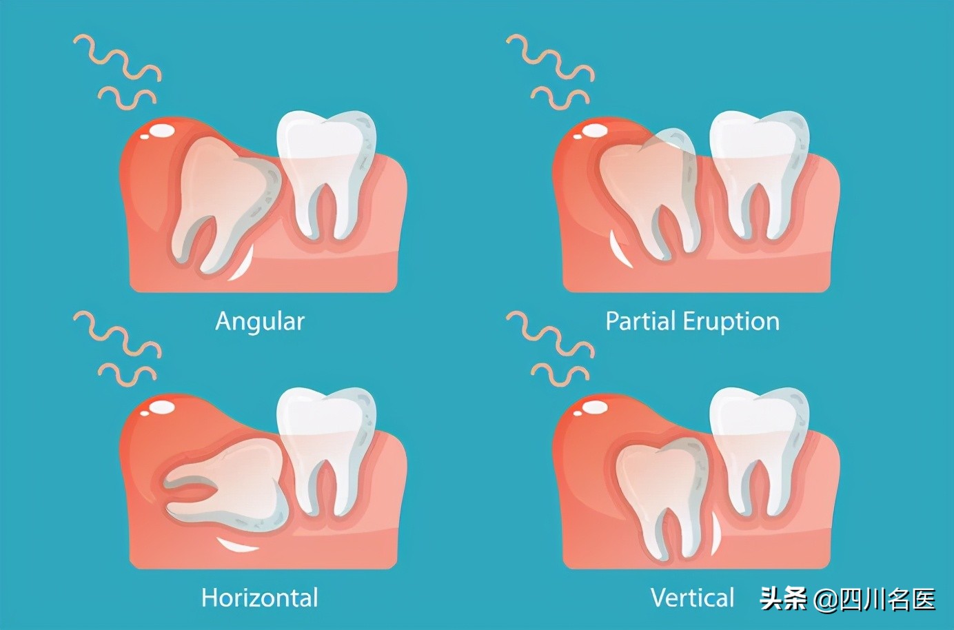 智齿一次拔几颗合适,智齿一定要拔吗几岁拔