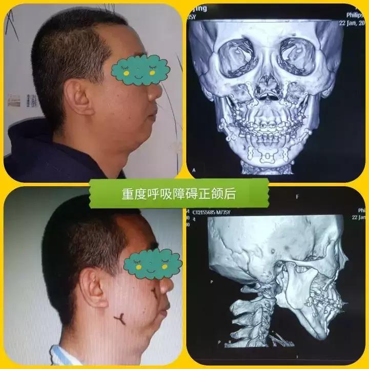 杭州38岁副教授决定锯掉下巴！睡觉一个习惯，让他长了一张“鸟嘴”