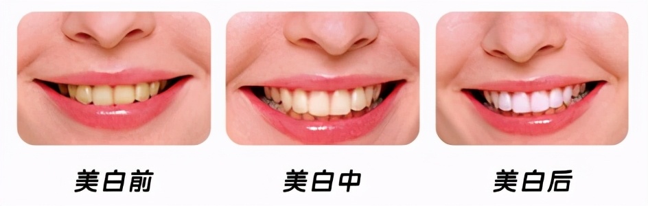 牙齿冷光美白和皓齿,皓齿美白大概多少钱