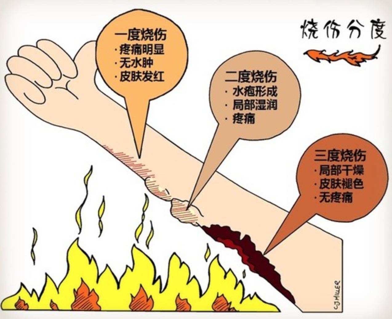 油炸烫伤治疗技巧,专治烧烫伤的验方分享简单实用