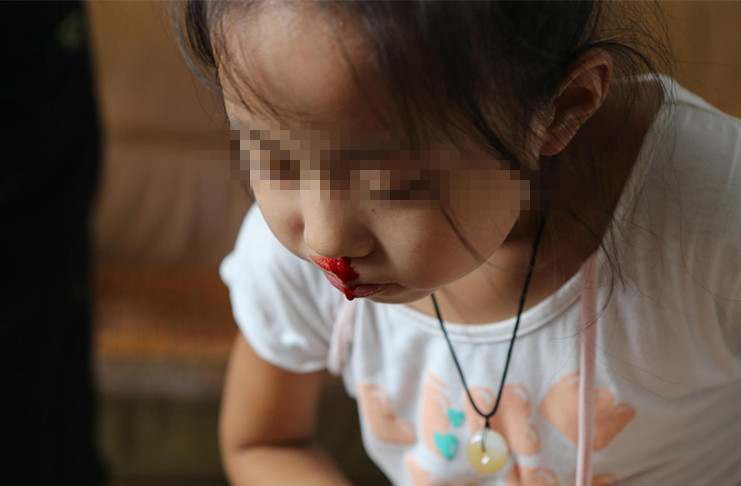 沙鼻子怎么治疗最有效,3岁宝宝沙眼怎么治