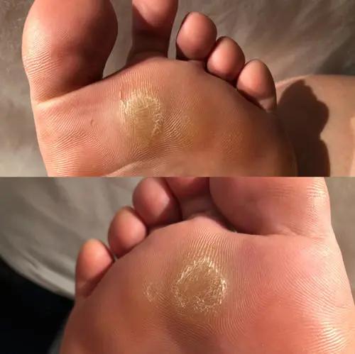 脚上有茧子是什么原因,如果脚上有茧皮怎么办