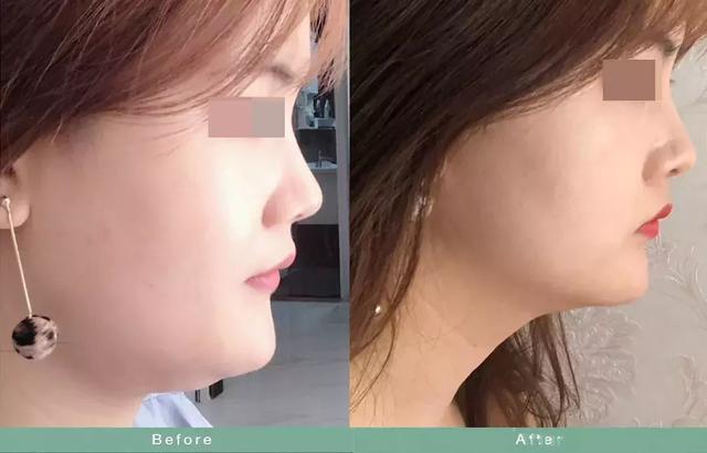 如何瘦双下巴和婴儿肥,小孩怎么快速减掉双下巴