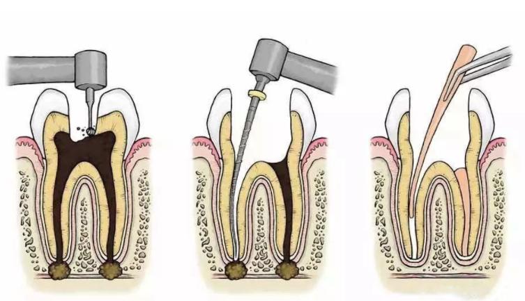 根管治疗后的牙齿能使用多久？听听良心牙医怎么说
