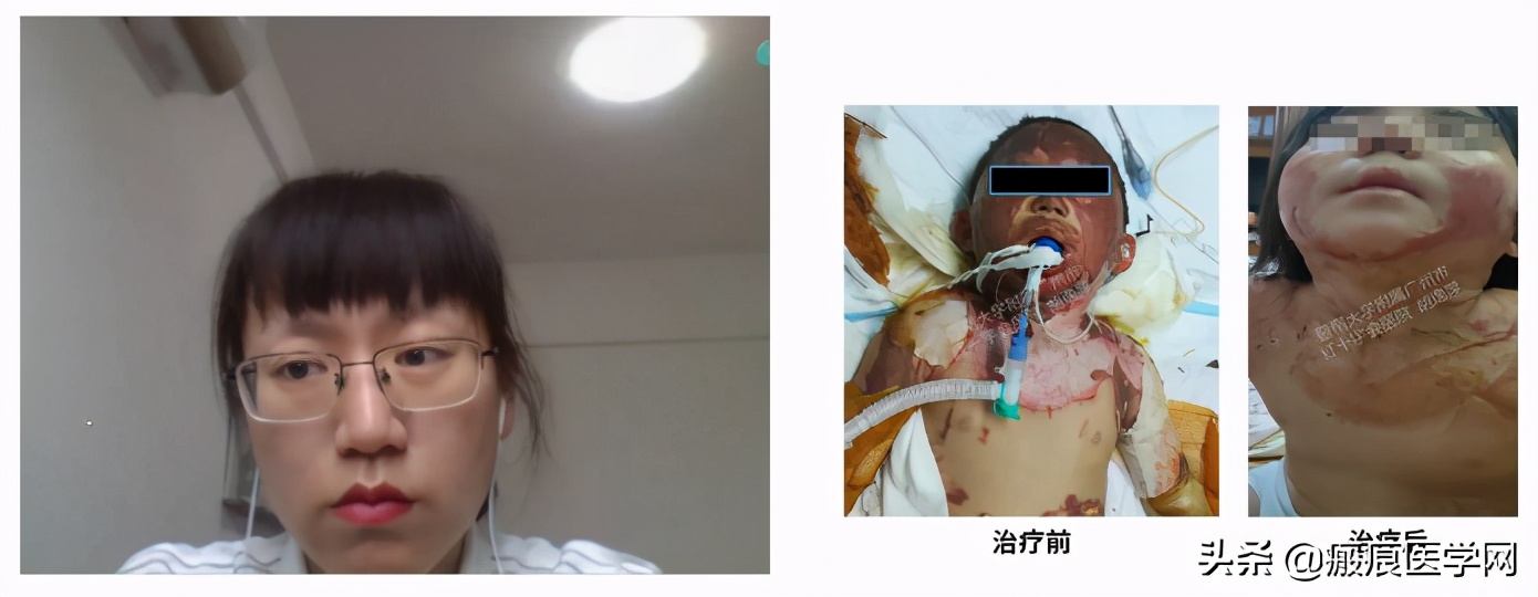 鐦㈢棔妗堜緥,鐤ょ棔娌荤枟鎴愬姛妗堜緥