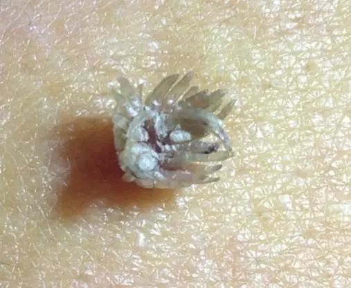 一般感染多久才得尖锐性湿疣,密恐慎入